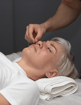 Acupuncture